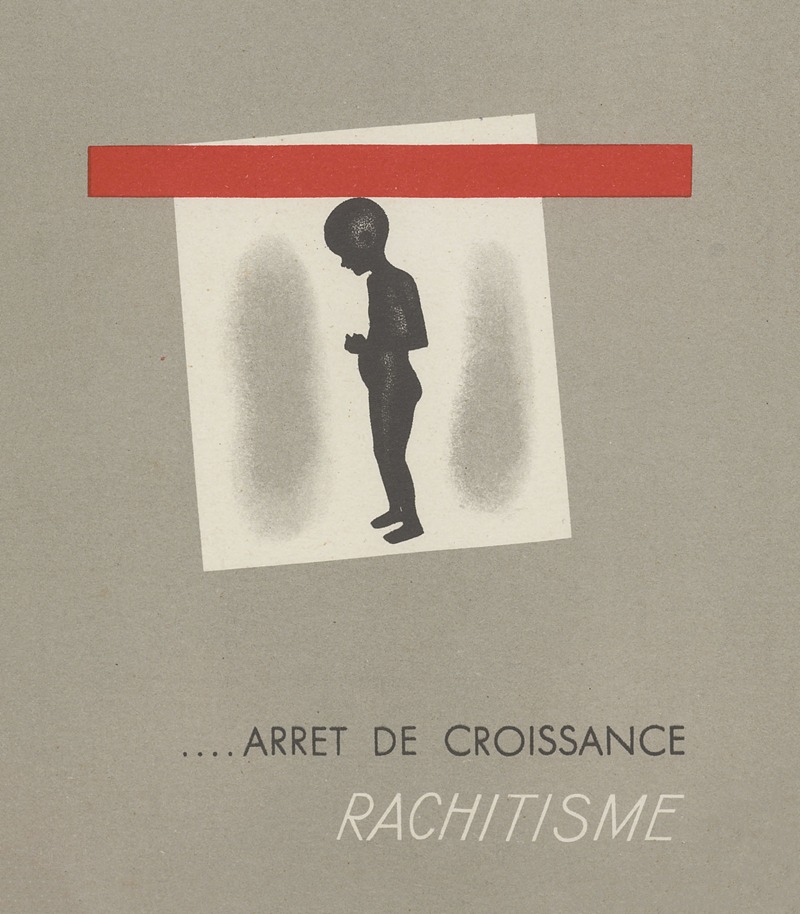 Arrêt de croissance ; rachitisme by Аноним, 1910-1950 — digital art print download
