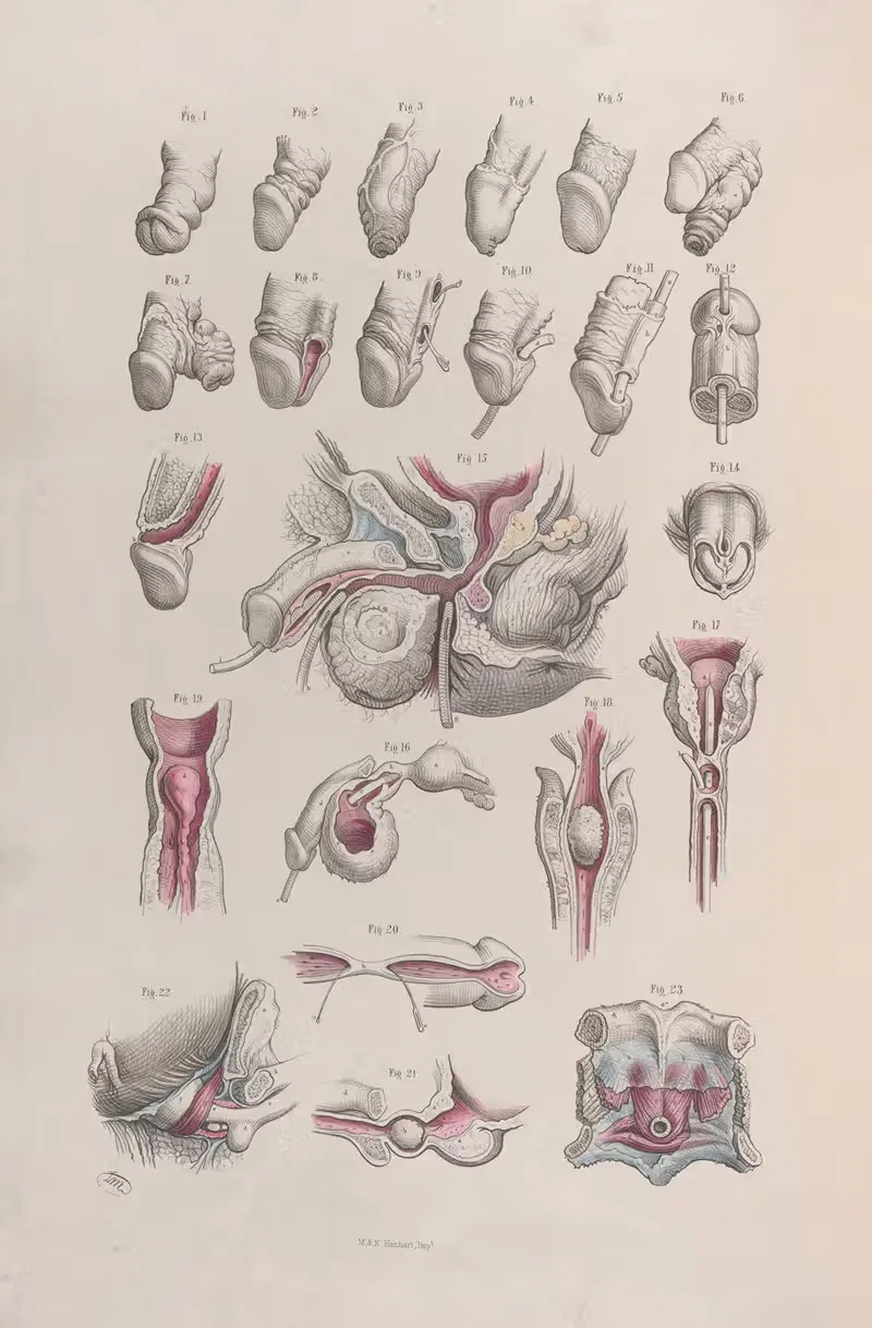 Хирургическая анатомия Пл.44 by Жозеф Макиллис, 1856 — digital art print download