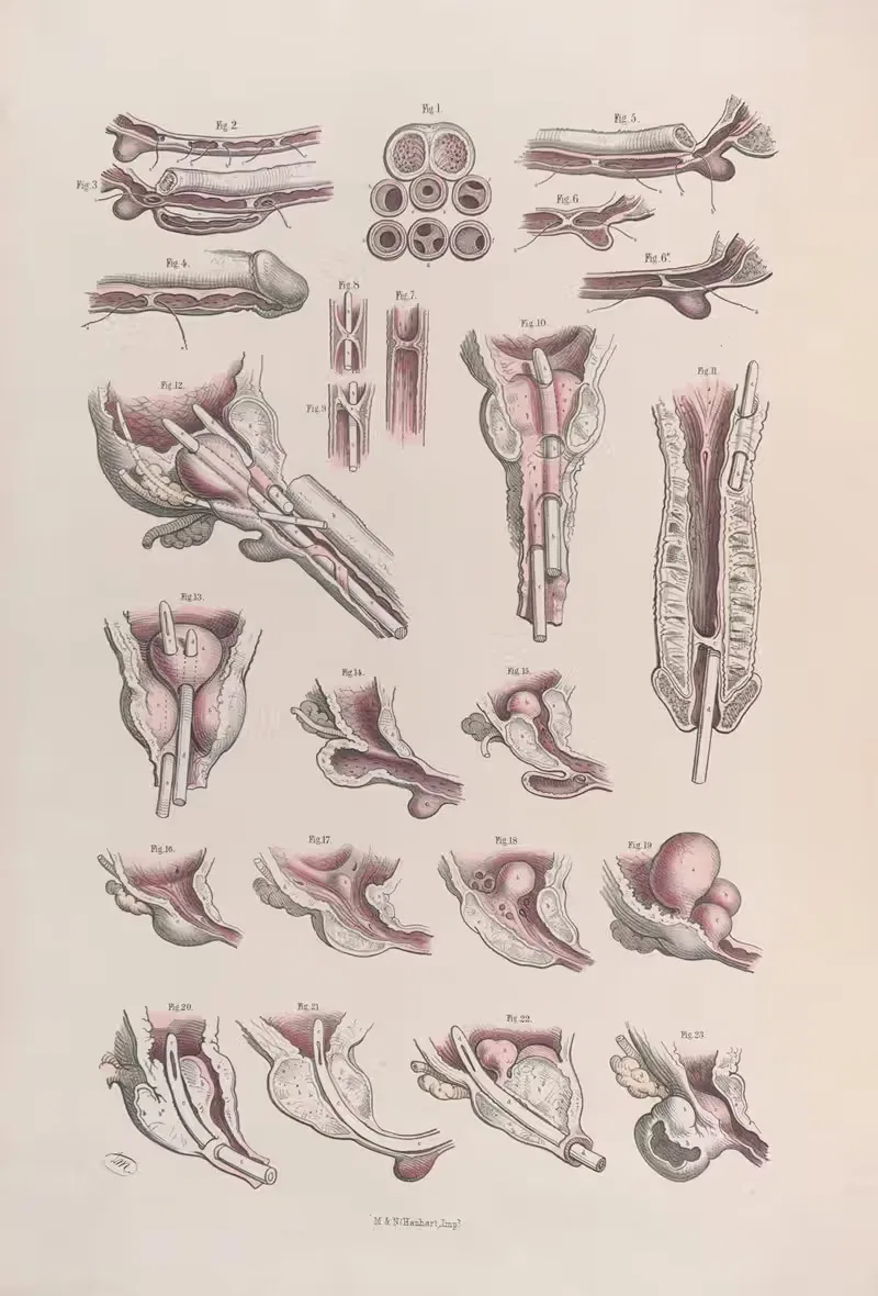 Хирургическая анатомия Пл.45 by Жозеф Макиллис, 1856 — digital art print download