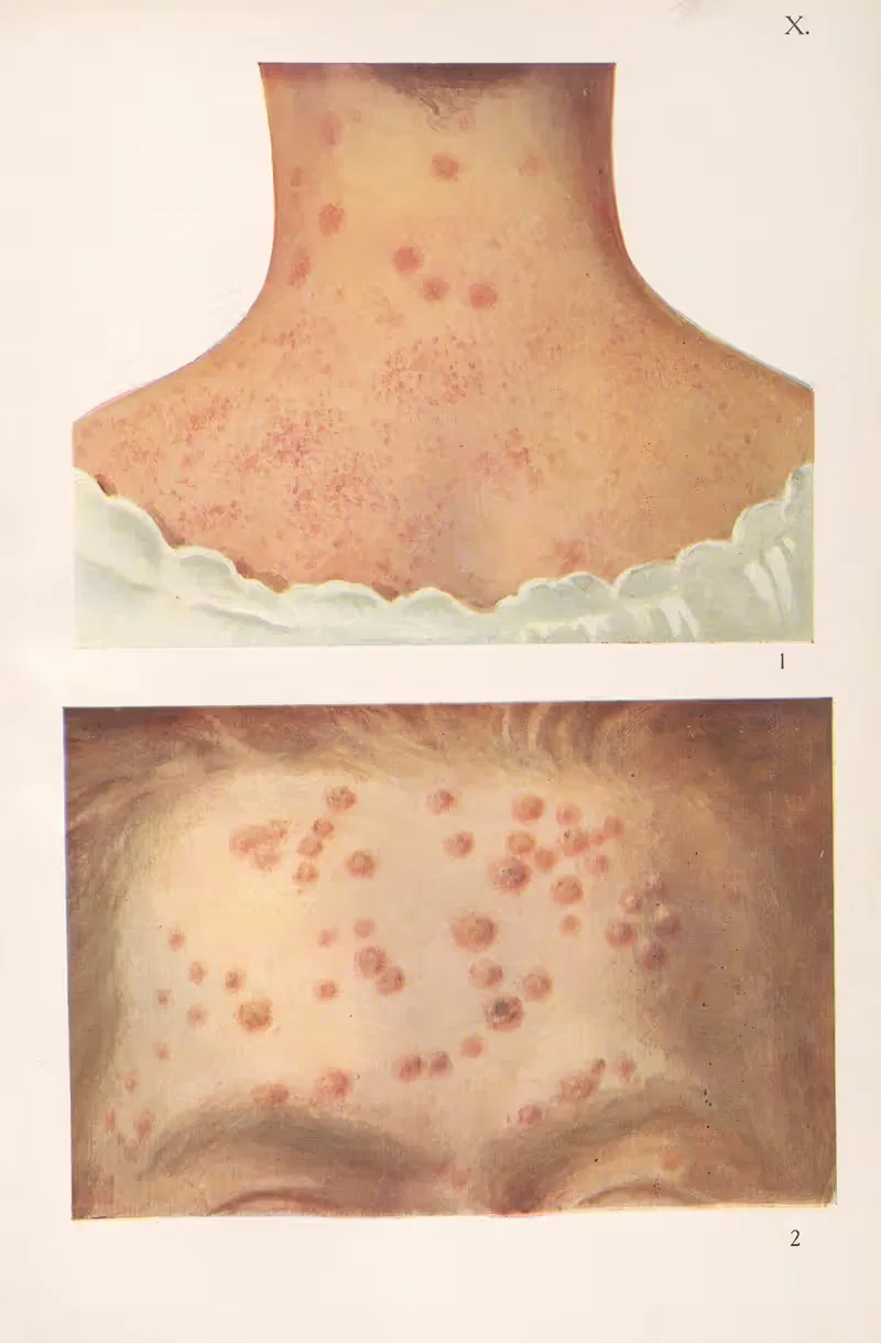 Venereal diseases – Syphilis Pl.10 — Feliks Malinowski