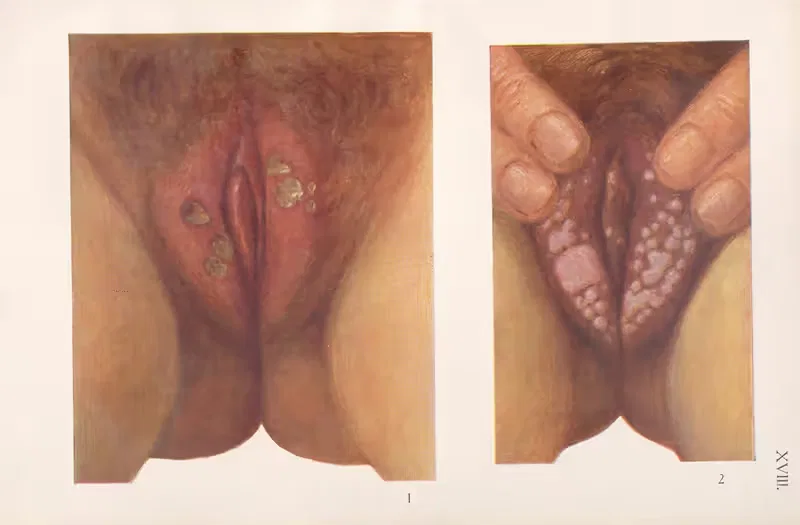Venereal diseases – Syphilis Pl.18 — Feliks Malinowski