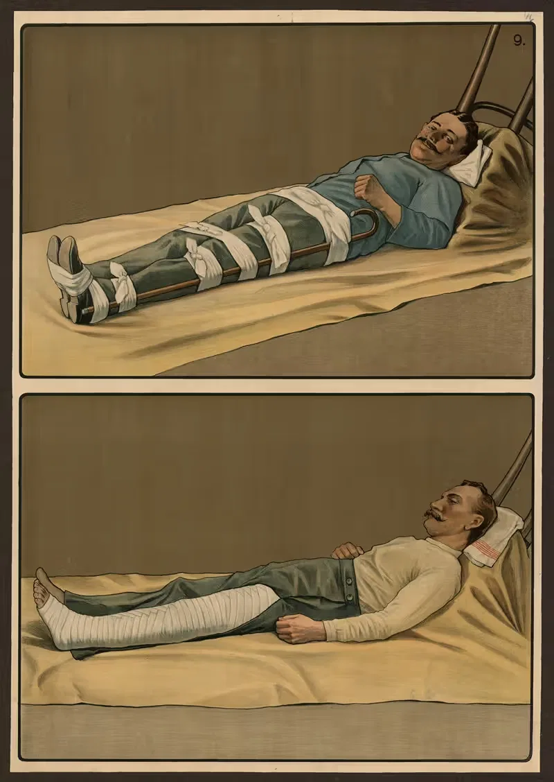 Экстренное лечение переломов by C.C. Майнхольд и сыновья, 1911 — digital art print download