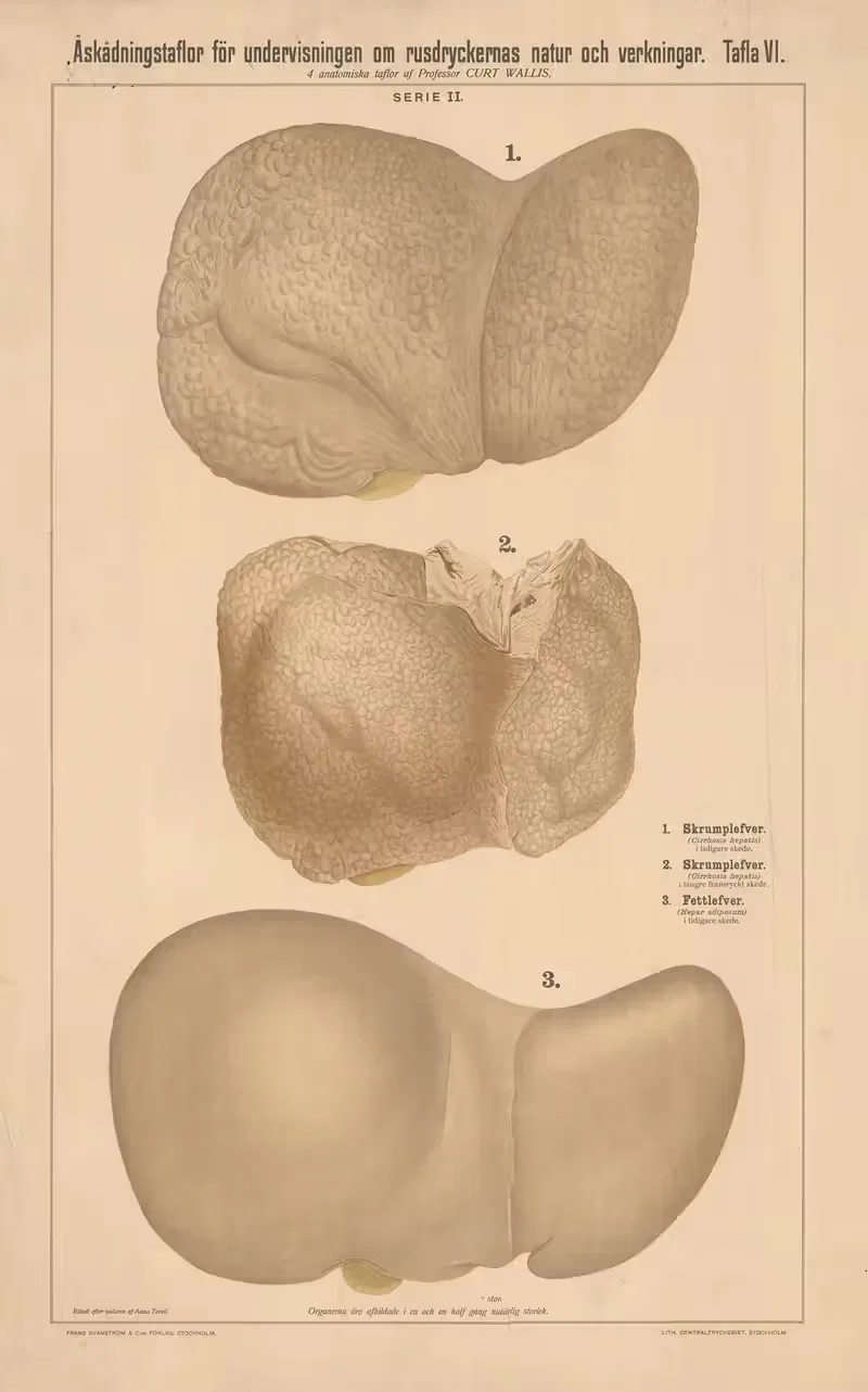 Cirrhosis and fatty liver — Anna Torell