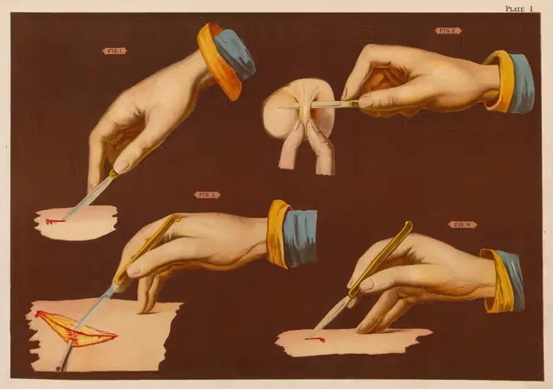 Methods of holding the bistoury — Elias Smith