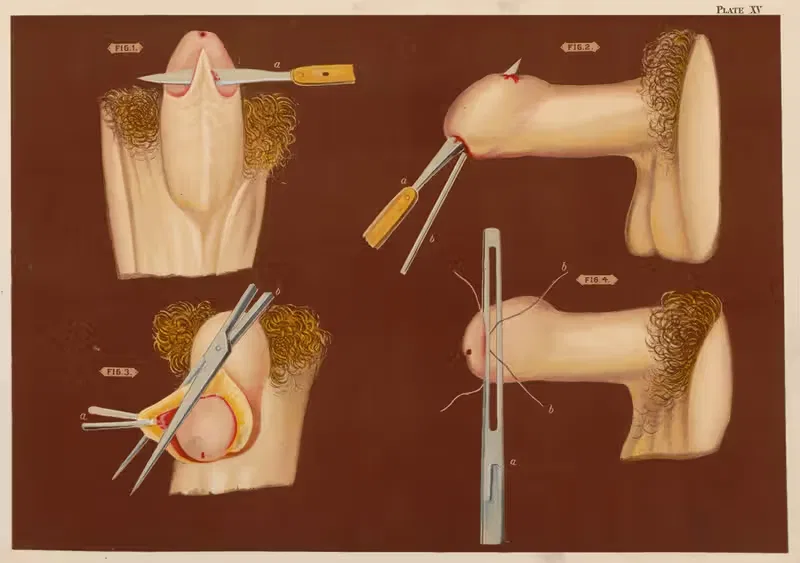 Operations upon the penis I by Elias Smith, 1889 — digital art print download