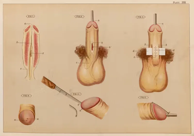 Operations upon the penis IV by Elias Smith, 1889 — digital art print download