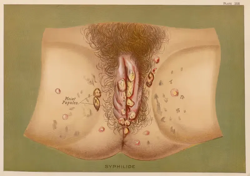 Secondary syphilitic eruptions and ulcerations — Elias Smith