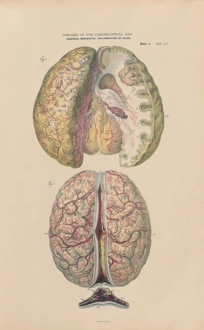 Acute sub-arachnoid meningitis by Jean Allard Jeancon, 1888 — digital art print download