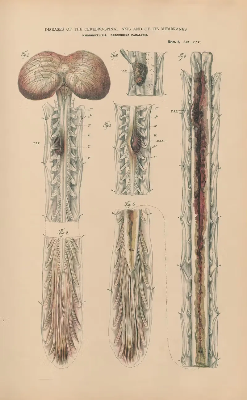 Haemomyelitis and descending paralysis by Jean Allard Jeancon, 1888 — digital art print download