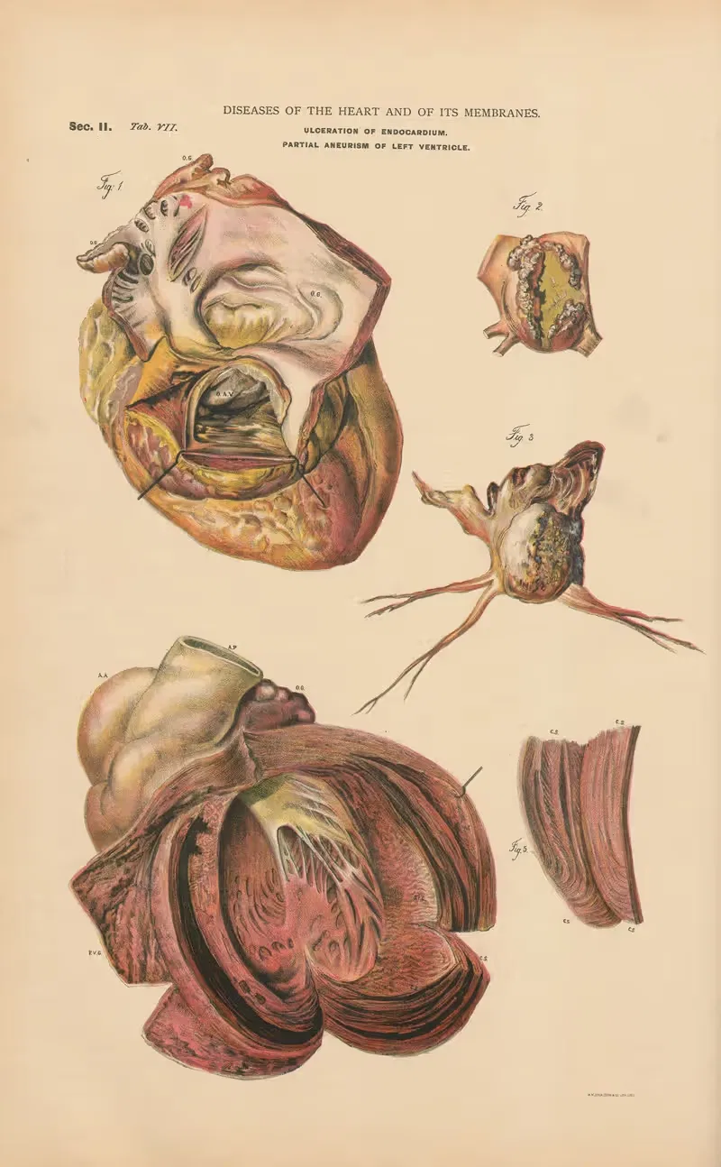 Ulceration of endocardium by Jean Allard Jeancon, 1888 — digital art print download