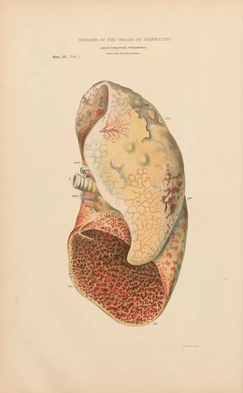Acute fibrinous pneumonia by Jean Allard Jeancon, 1888 — digital art print download