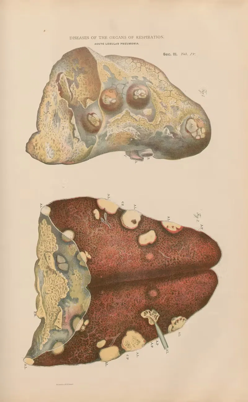 Lobular pneumonia, subsequent to phlebitis by Jean Allard Jeancon, 1888 — digital art print download