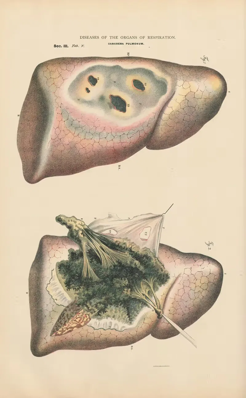 Diffuse Gangrene of right lung by Jean Allard Jeancon, 1888 — digital art print download