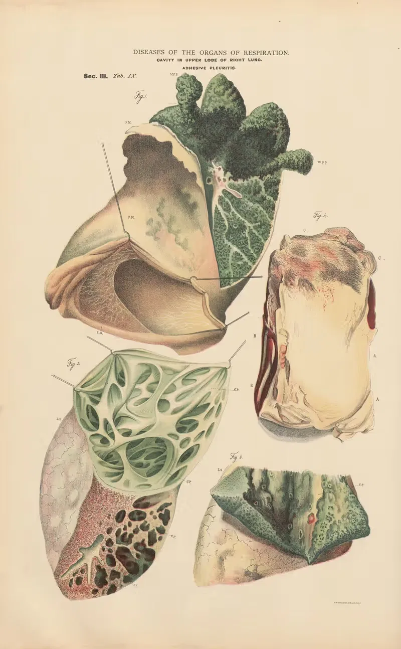 Cavity in upper lobe of right lung — Jean Allard Jeancon