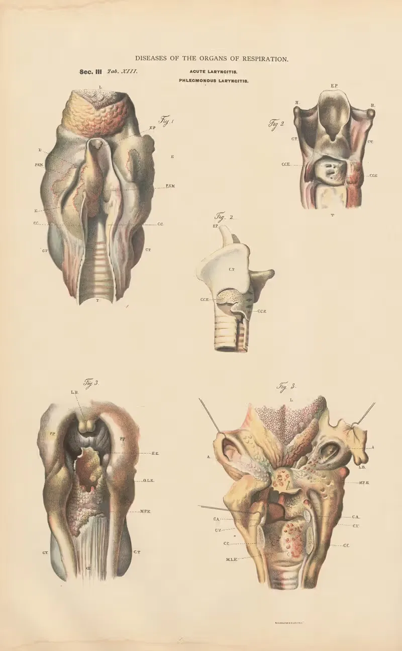 Acute Laryngitis; oedematous infiltration by Jean Allard Jeancon, 1888 — digital art print download