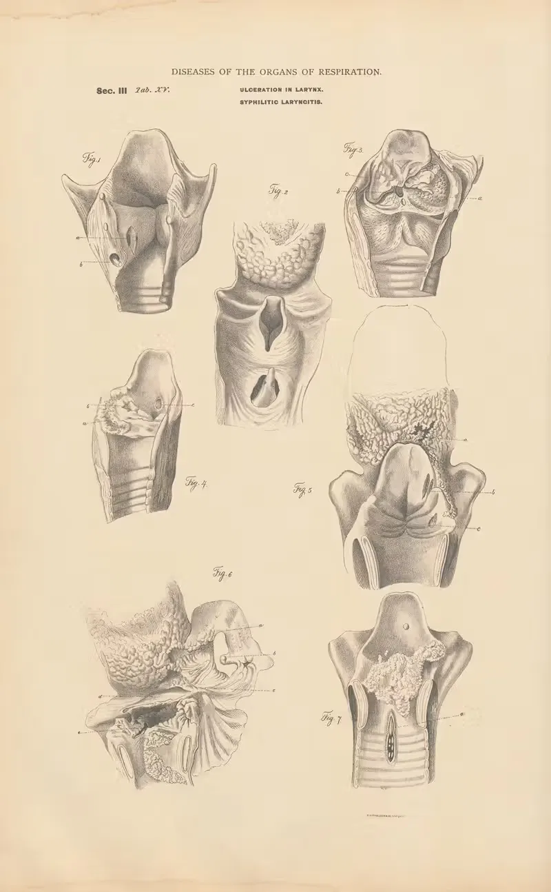 Perichondritis of cricoid cartilage — Jean Allard Jeancon