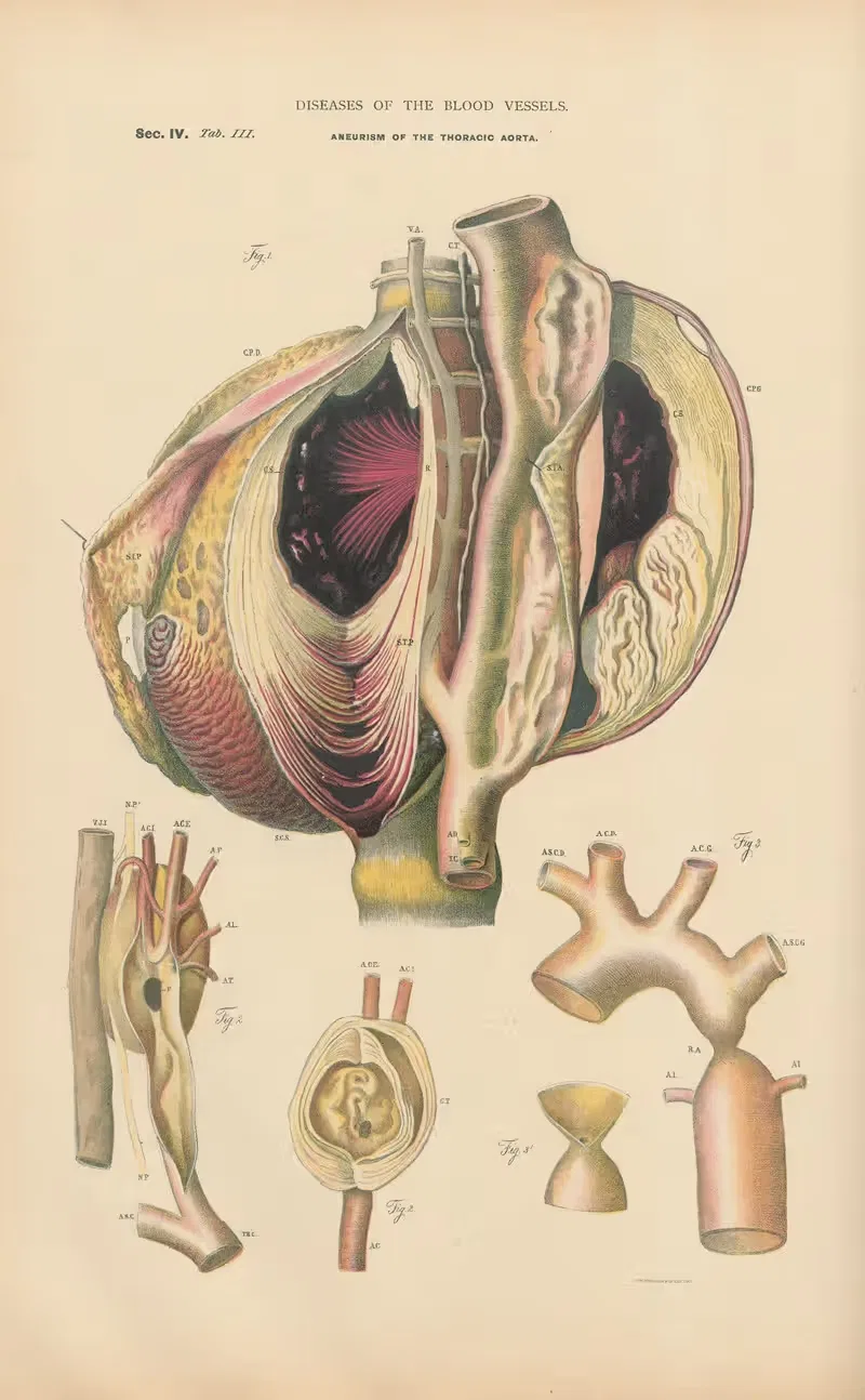 Aneurism of Thoracic aorta — Jean Allard Jeancon