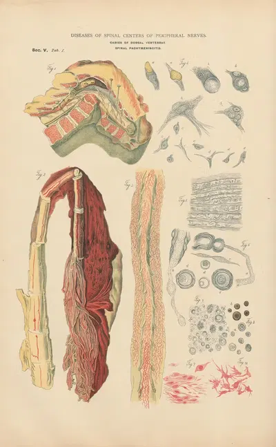Caries of middle dorsal vertebra with posterior kyphosis by Jean Allard Jeancon, 1888 — digital art print download