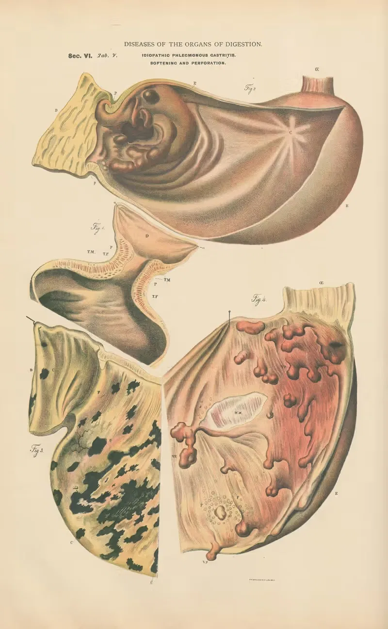 Idiopathic phlegmonous Gastritis. Softening — Jean Allard Jeancon