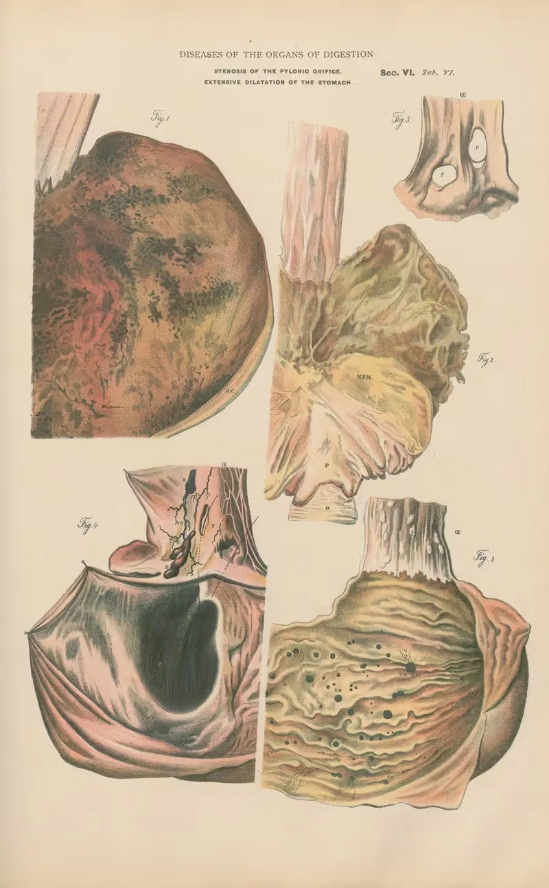 Gastric Lesions. Extensive delatation by Jean Allard Jeancon, 1888 — digital art print download