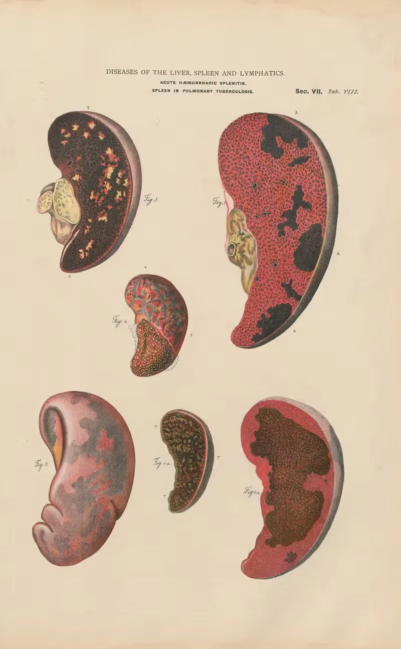 Splenitis and infarct, with abcesses by Jean Allard Jeancon, 1888 — digital art print download