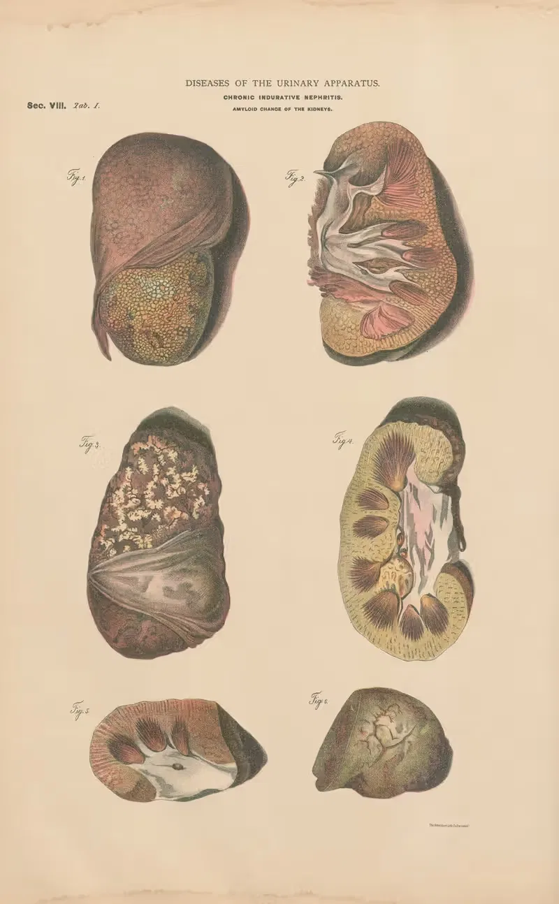 Chronic Nephritis and induration by Jean Allard Jeancon, 1888 — digital art print download