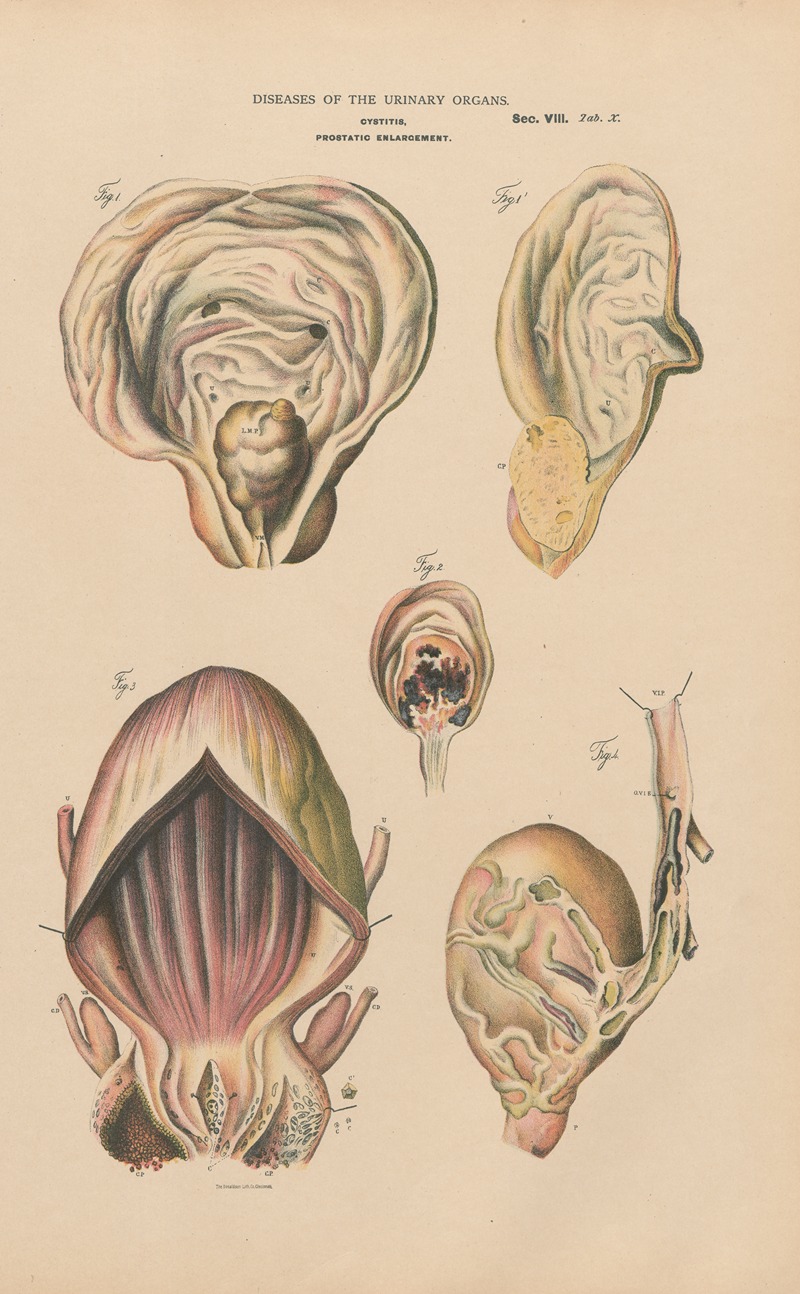 Cystitis and prostatic enlargement. Prostatic calculus. Vesical phlibitis by Jean Allard Jeancon, 1888 — digital art print…