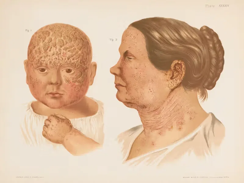 I. Eczema capitis, II. Eczema faciei — Prince Albert Morrow