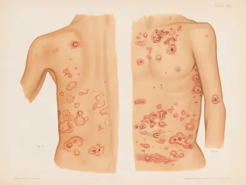 I. Dermatitis herpetiformis, II. Dermatitis herpetiformis (back view) — Prince Albert Morrow