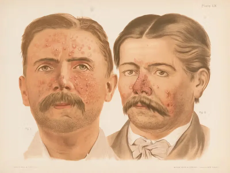 I. Acne vulgaris, II. Acne rosacea — Prince Albert Morrow