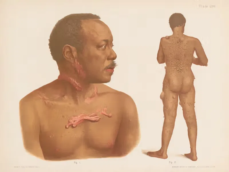 I. Keloid, II. Fibroma — Prince Albert Morrow