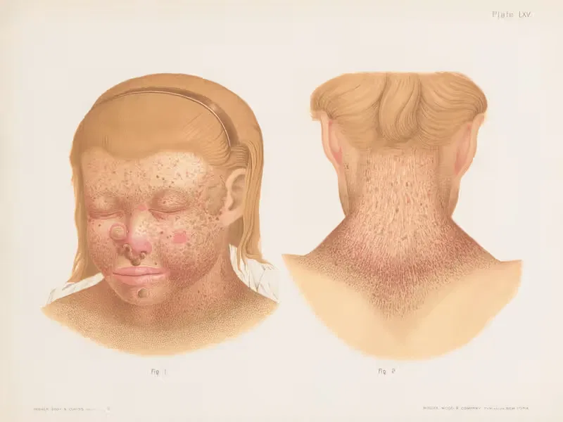 I. and II. Xeroderma pigmentosum by Prince Albert Morrow, 1888-1889 — digital art print download