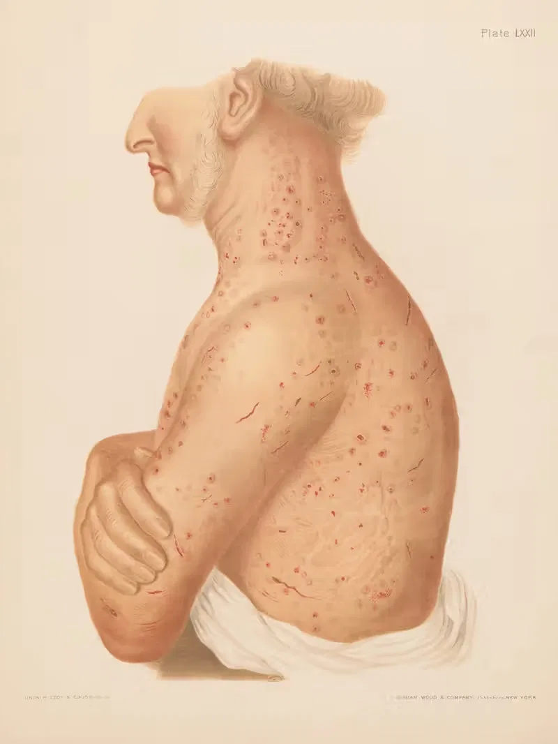 Pediculosis Corporis — Prince Albert Morrow