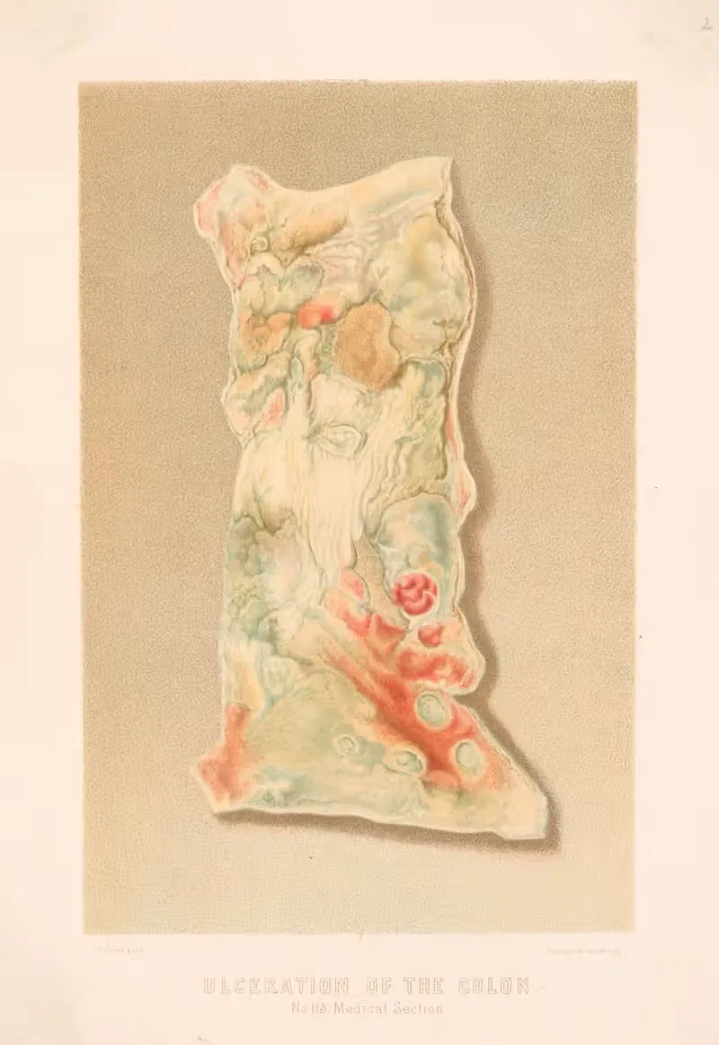 Ulceration of the colon — United States Surgeon-General's Office