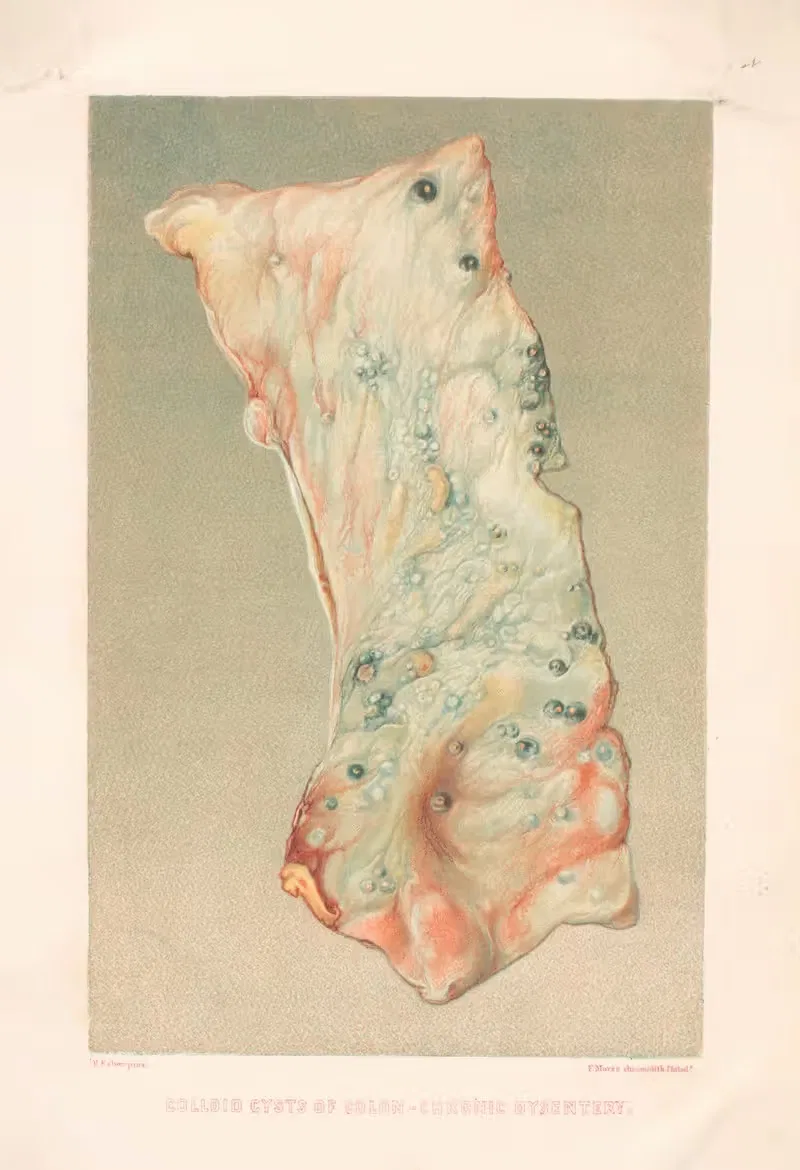 Colloid cysts of Colon-Chronic dysentry — United States Surgeon-General's Office
